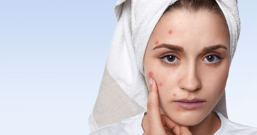 Deep Acne Treatment