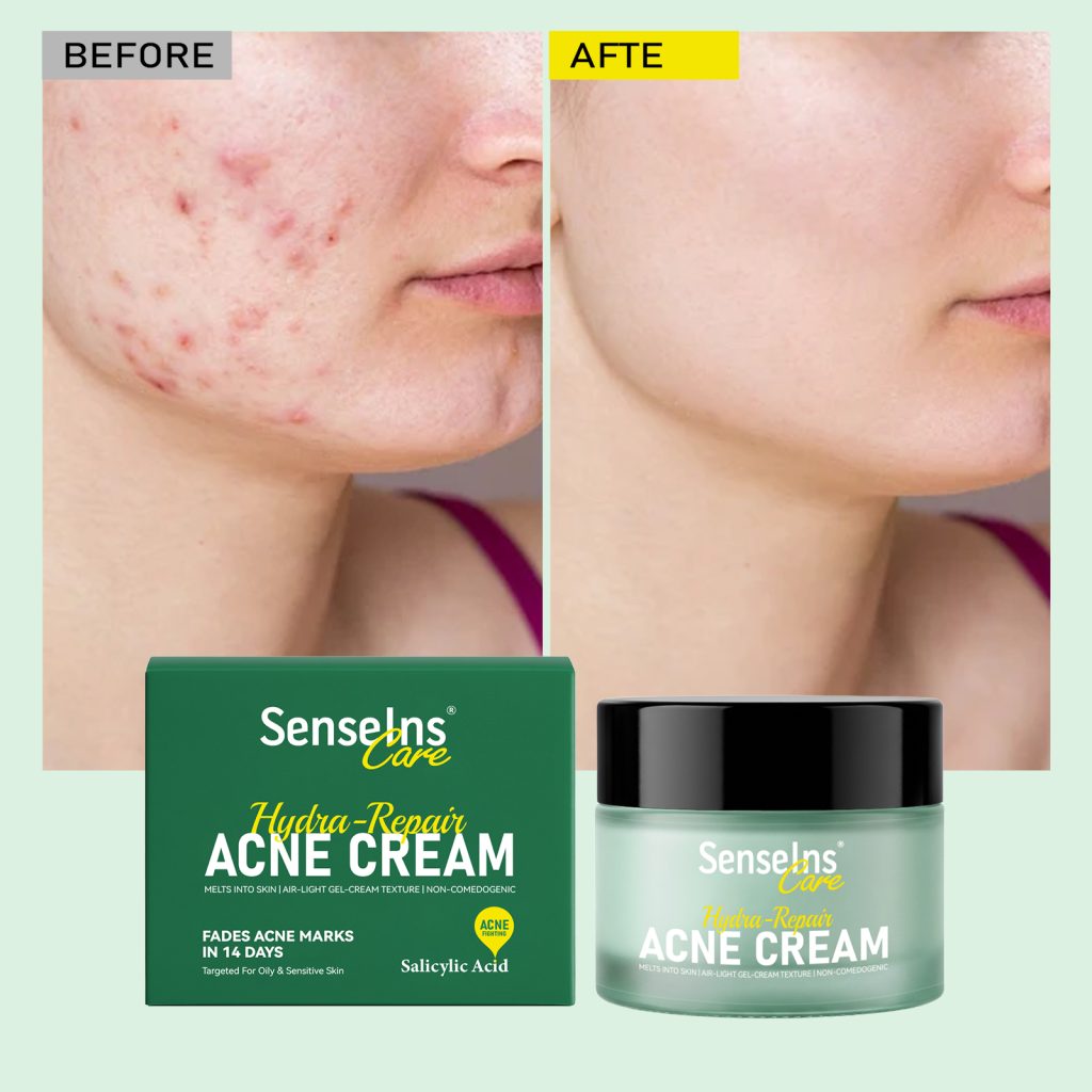  Acne Removal Cream