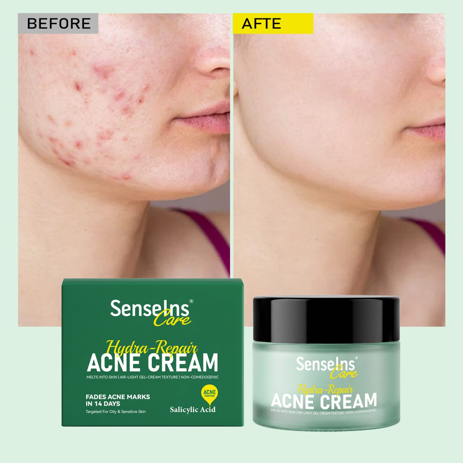 Gentle Non-Comedogenic Acne Cream That Delivers Results
